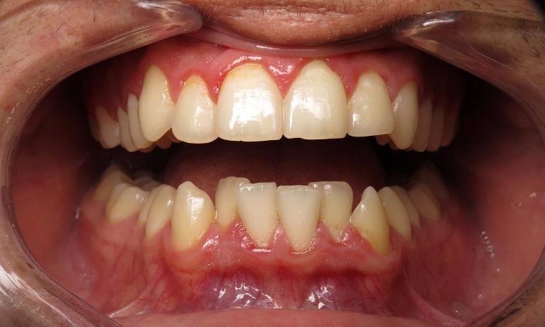 Invisalign-After-Image