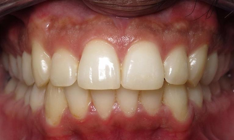 Invisalign-Clear-Aligners-After-Image