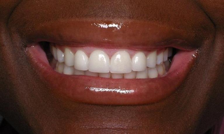 Dental-Veneers-After-Image