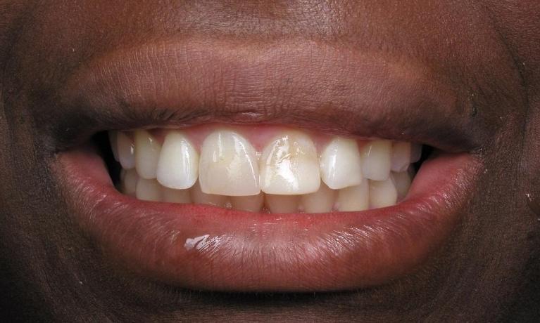 Dental-Veneers-Before-Image